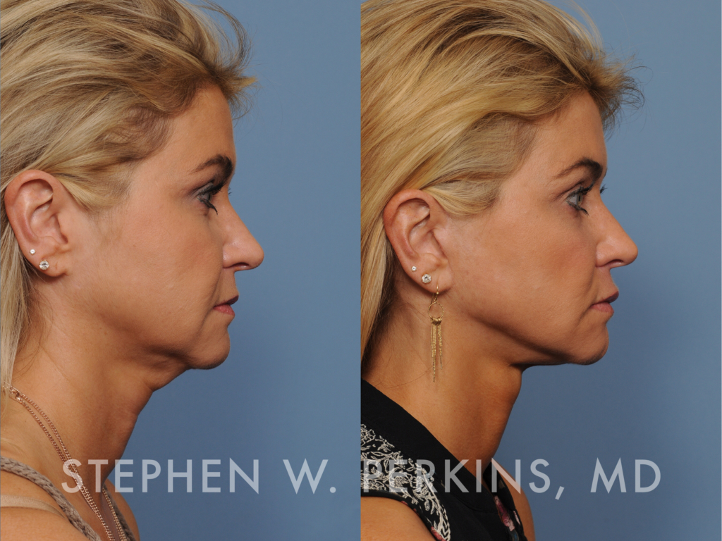 Indianapolis Facial Plastic Surgeons | Dr. Stephen Perkins, MD Diana