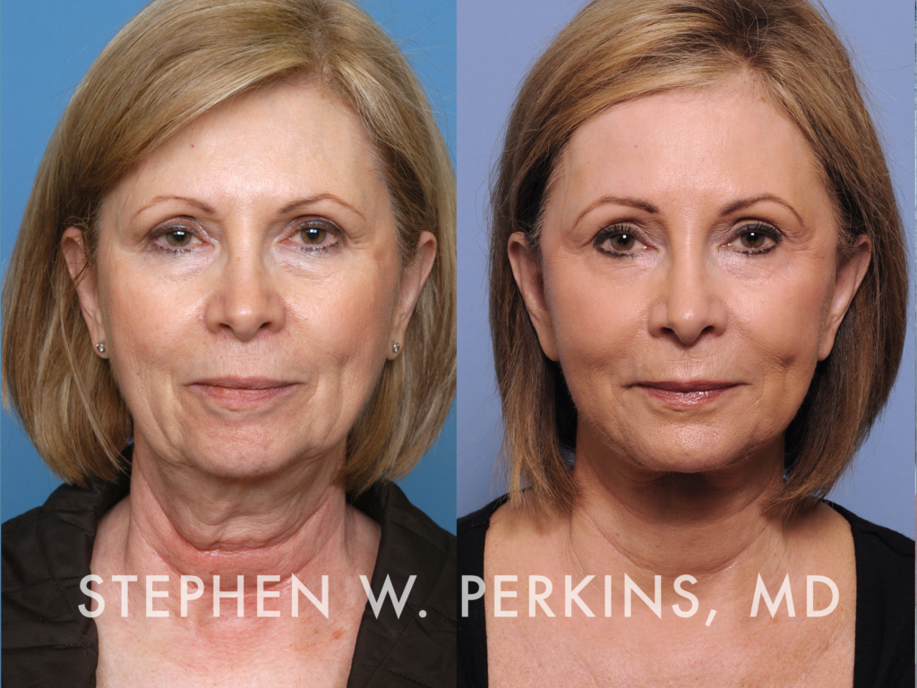 Indianapolis Facial Plastic Surgeons | Dr. Stephen Perkins, MD Nathalie