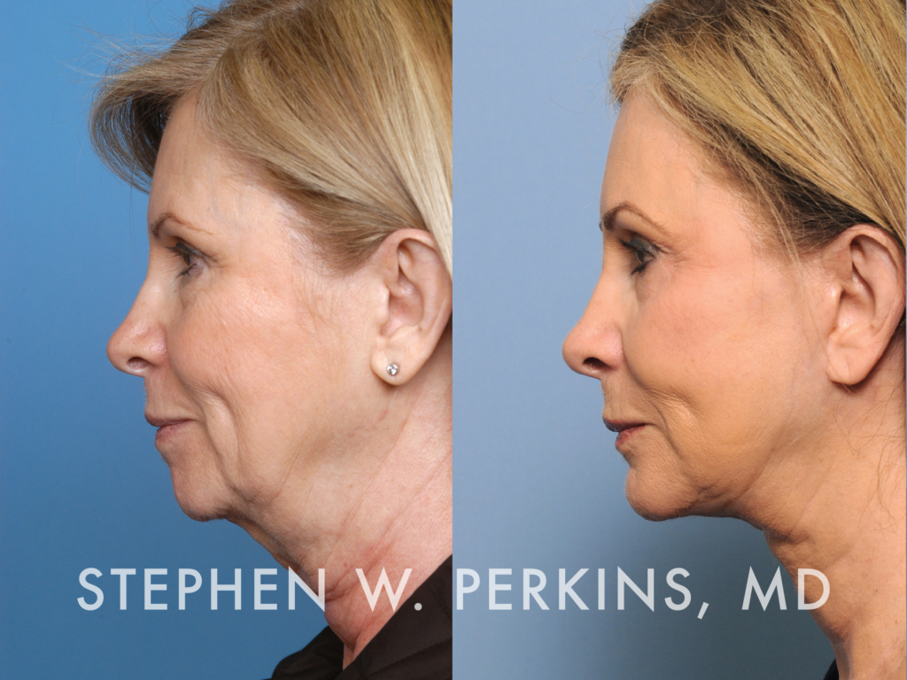 Indianapolis Facial Plastic Surgeons | Dr. Stephen Perkins, MD Nathalie