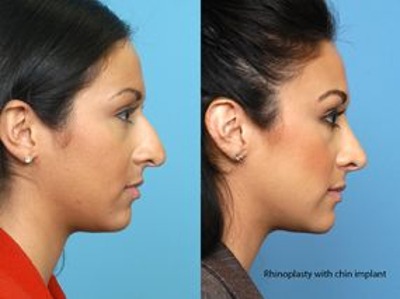 Indianapolis Facial Plastic Surgeons | Dr. Stephen Perkins, MD Today's Nose: What's Changed With Rhinoplasty