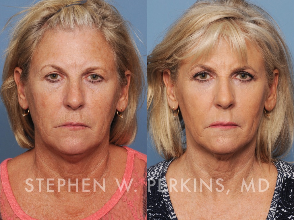Indianapolis Facial Plastic Surgeons | Dr. Stephen Perkins, MD Yvonne