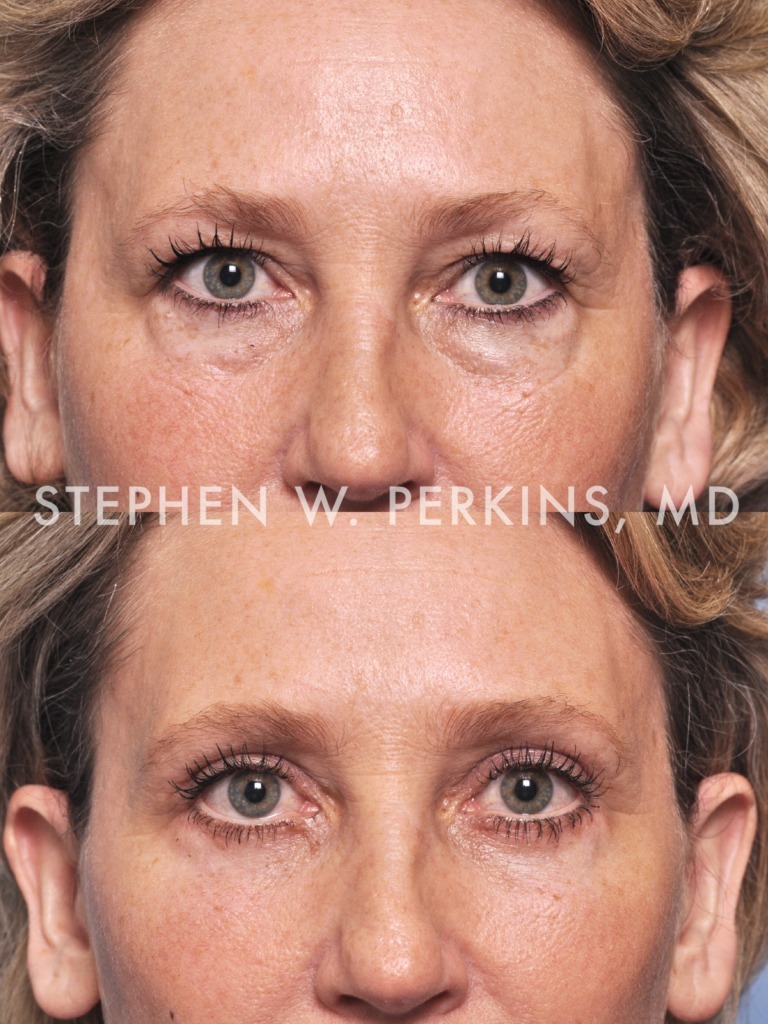 Indianapolis Facial Plastic Surgeons | Dr. Stephen Perkins, MD Gallery