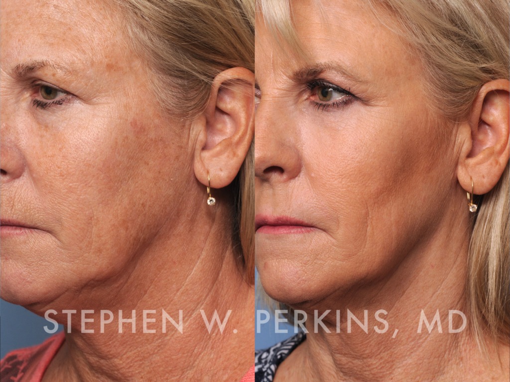 Indianapolis Plastic Surgeons | Dr. Stephen Perkins, MD Yvonne