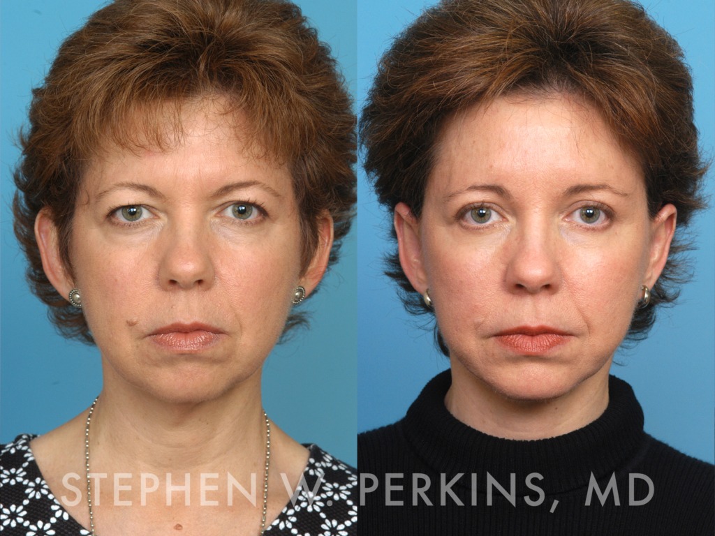 Indianapolis Facial Plastic Surgeons | Dr. Stephen Perkins, MD Otoplasty