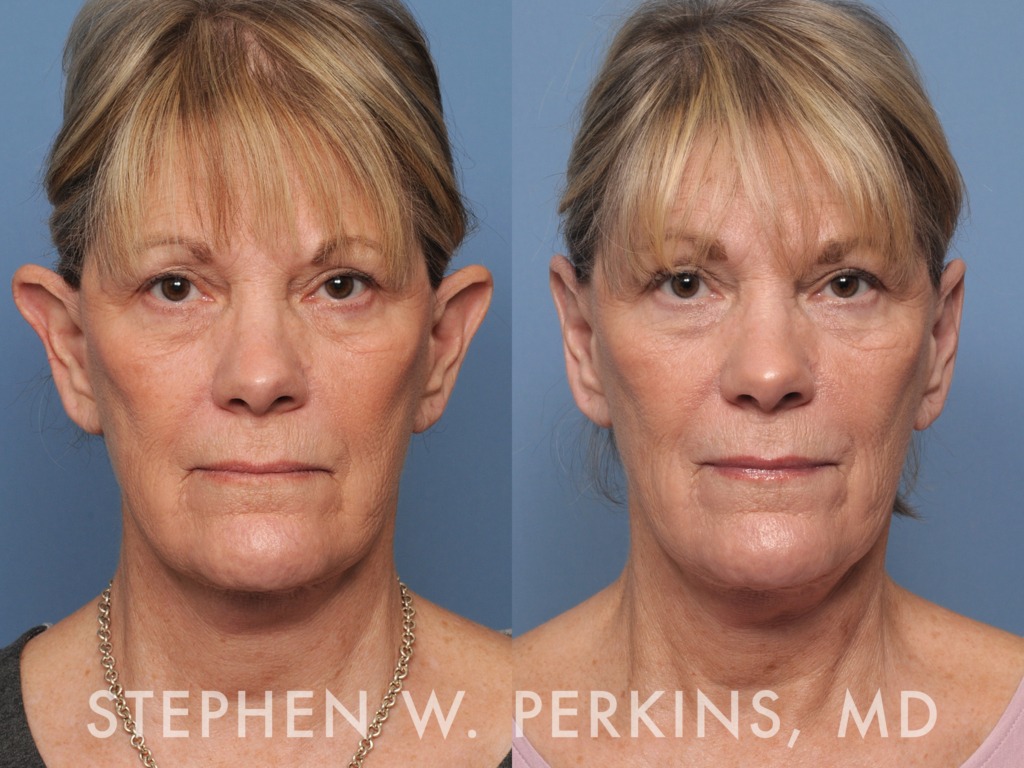 Indianapolis Facial Plastic Surgeons | Dr. Stephen Perkins, MD Otoplasty