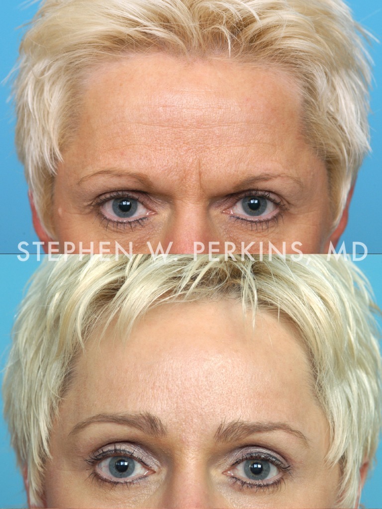 Indianapolis Plastic Surgeons | Dr. Stephen Perkins, MD Gallery