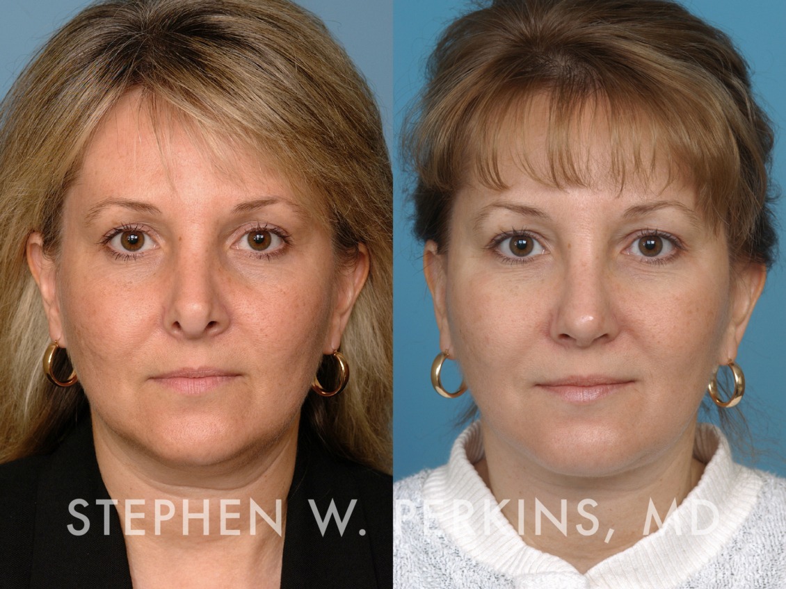 Revision Rhinoplasty – Indianapolis Facial Plastic Surgeons | Dr ...