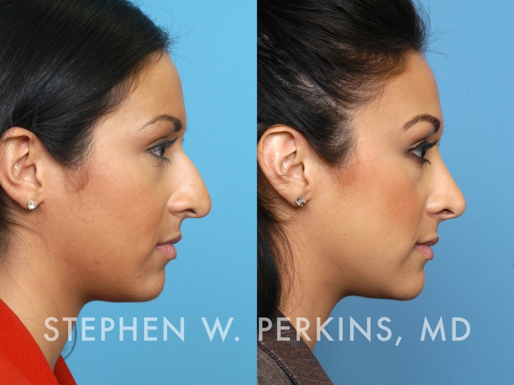 Indianapolis Facial Plastic Surgeons | Dr. Stephen Perkins, MD Michelle