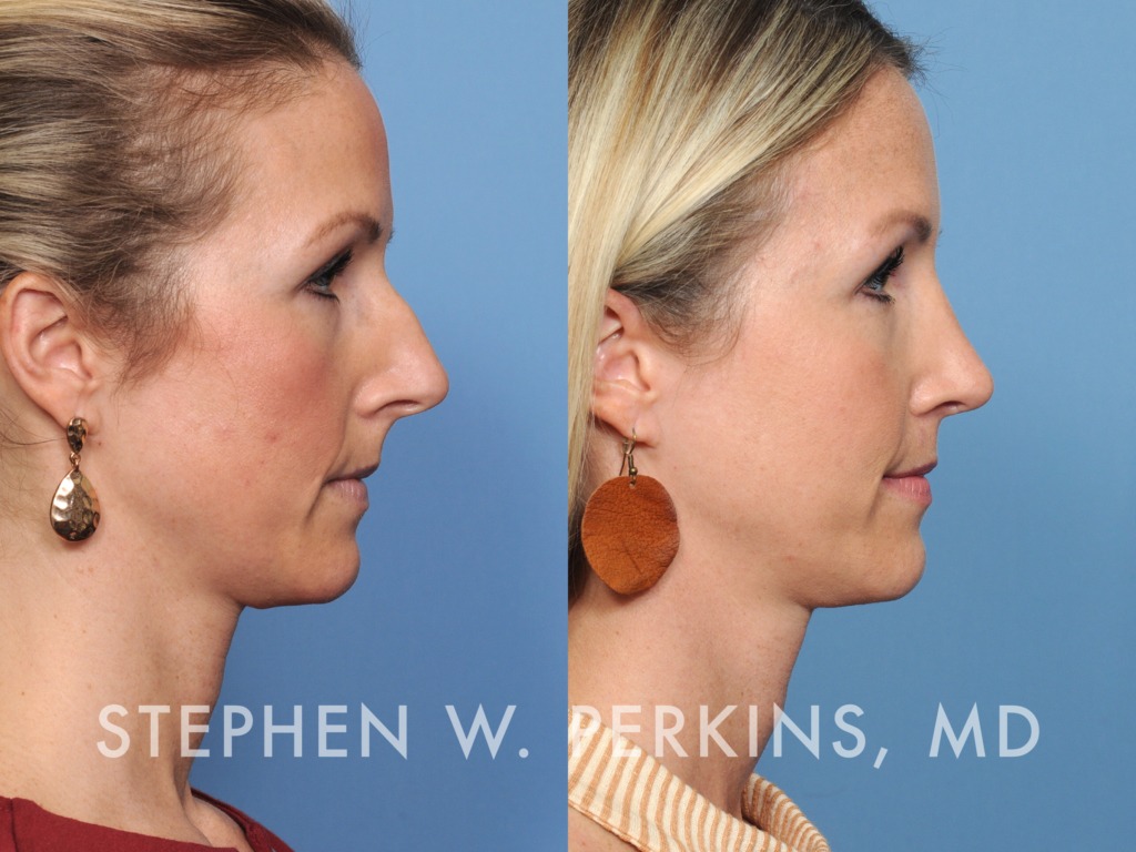 Indianapolis Facial Plastic Surgeons | Dr. Stephen Perkins, MD Gallery