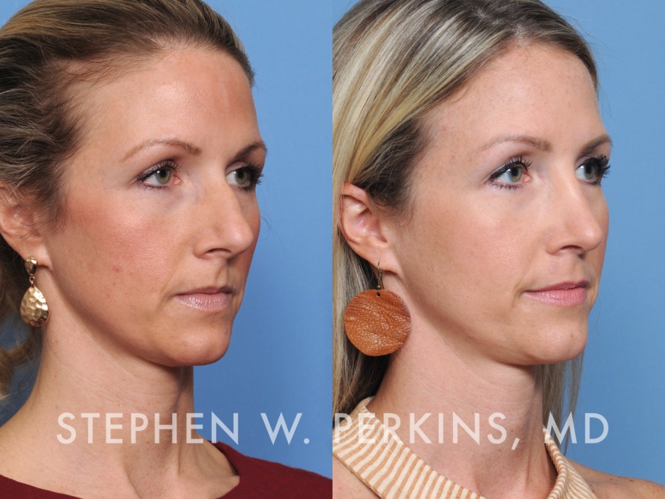 Rhinoplasty – Indianapolis Facial Plastic Surgeons | Dr. Stephen ...