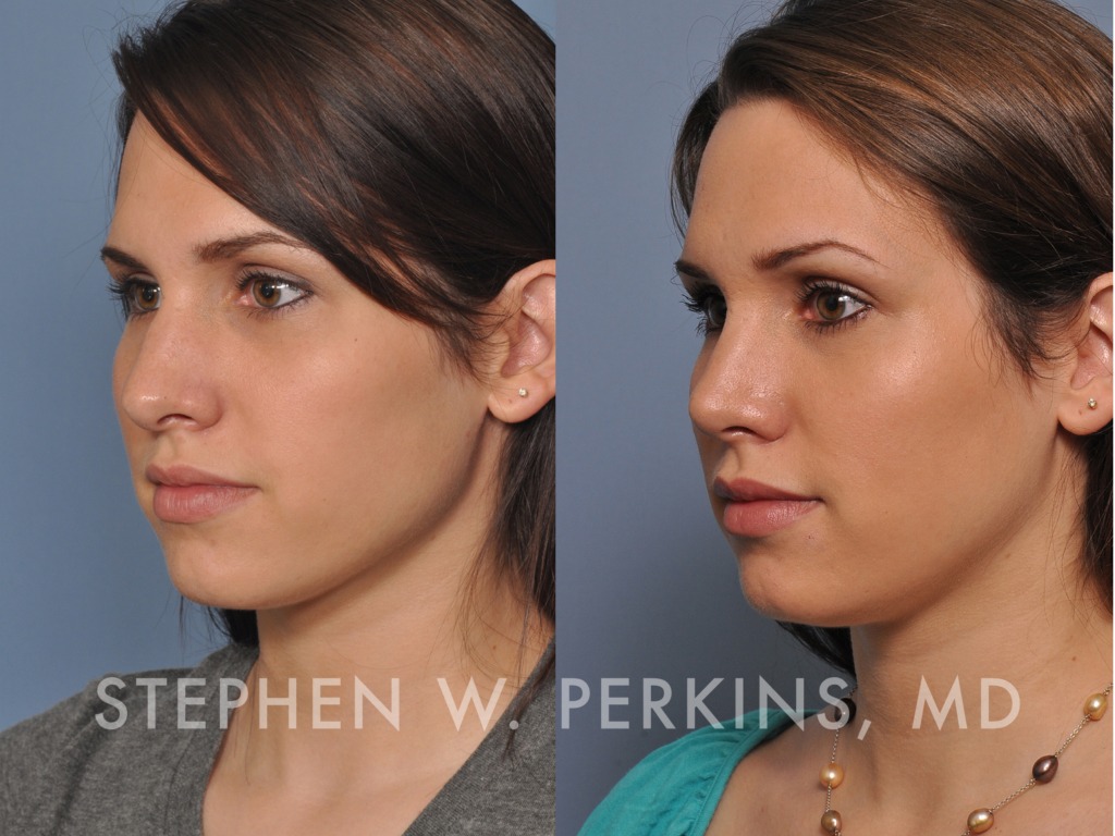 Indianapolis Facial Plastic Surgeons | Dr. Stephen Perkins, MD Christine